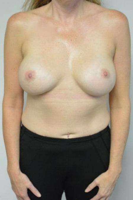 After image 1 Case #88096 - 45-55 year woman treated with Ideal Structured Saline Implants