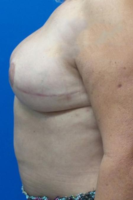 After image 3 Case #87326 - Breast Reconstruction Revision