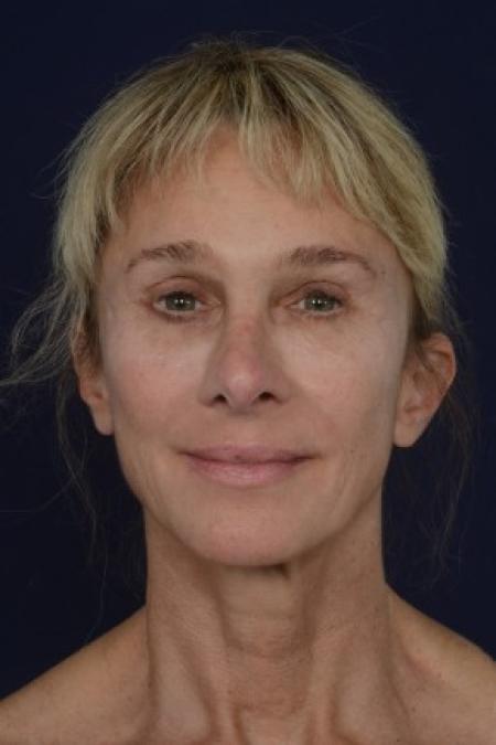 After image 1 Case #87626 - Structural Fat Grafting