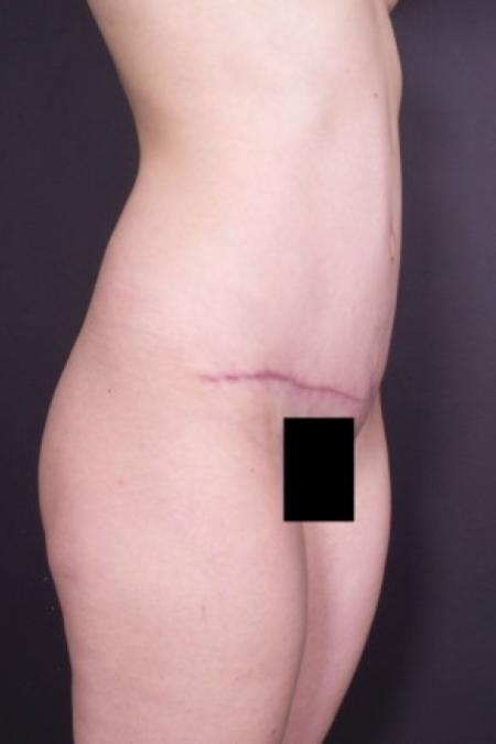 After image 2 Case #85826 - Abdominoplasty