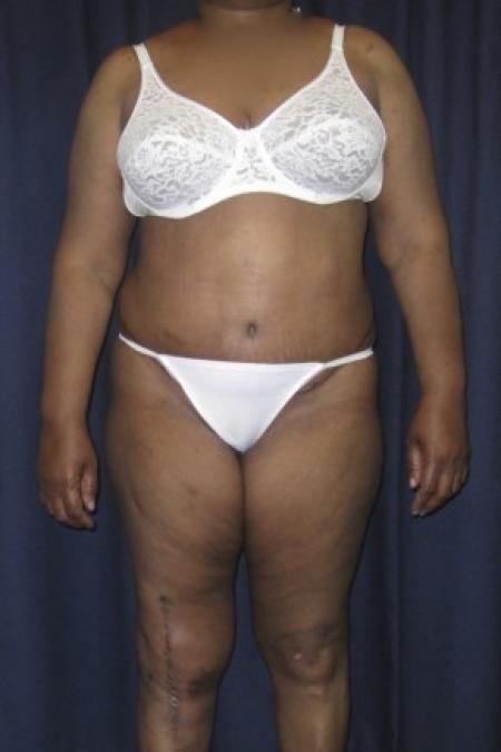 After image 1 Case #82201 - LipoAbdominoplasty