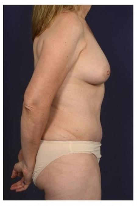 After image 3 Case #84756 - Mommy Makeover