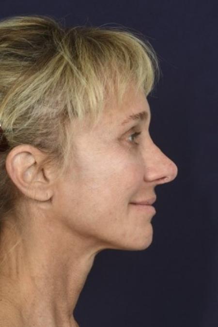 After image 3 Case #87126 - Structural Fat Grafting