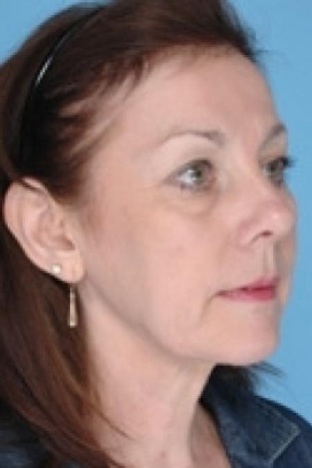 After image 2 Case #79316 - Non-Surgical Focused Ultrasound