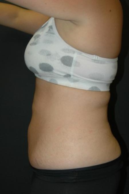 After Case #81341 - Coolsculpting Procedure on Upper Abdomen