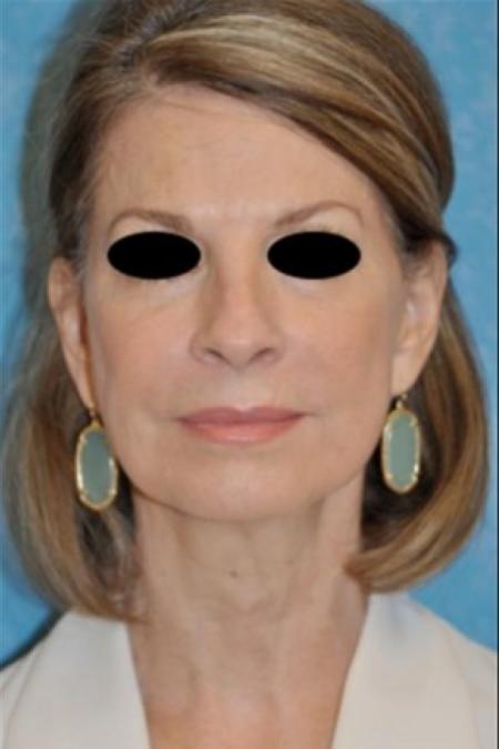 After image 1 Case #83416 - Face and Neck Lift 