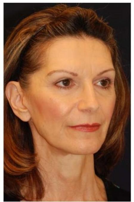 After image 2 Case #82036 - Full Facial Rejuvenation