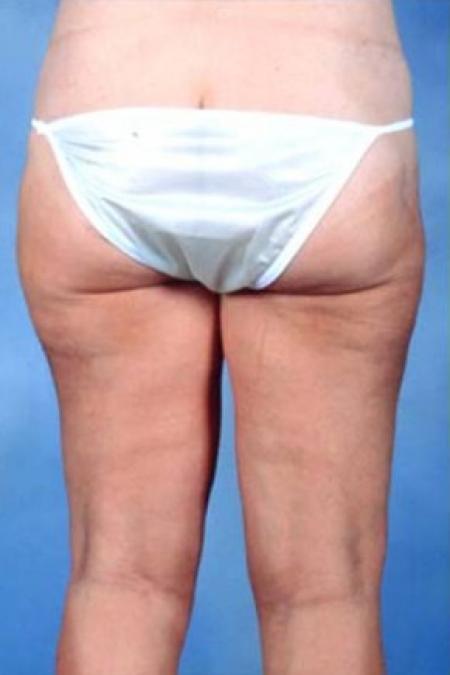 After image 1 Case #81651 - Liposuction