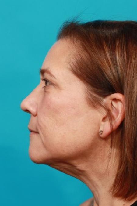 After image 3 Case #85621 - Neck / Lower Face Lift