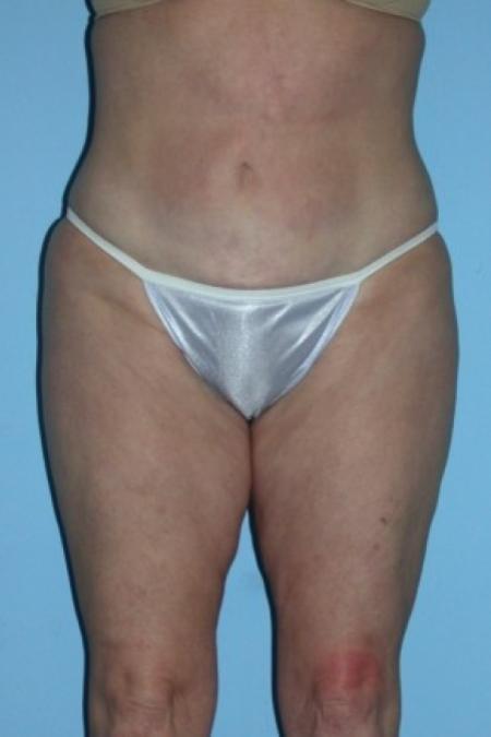 After image 1 Case #82271 - Liposuction