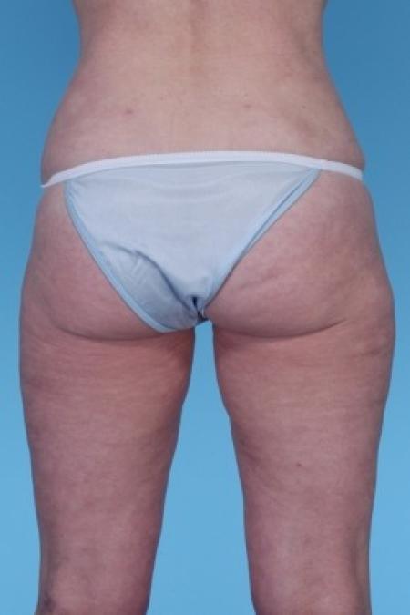 After image 2 Case #82281 - Liposuction