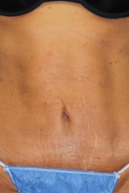 After image 1 Case #80831 - Liposuction with "mini tummy-tuck"