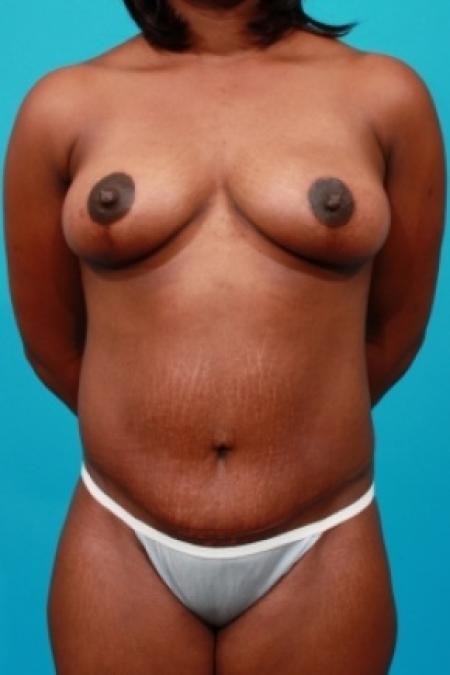 After image 1 Case #78721 - Mommy Makeover