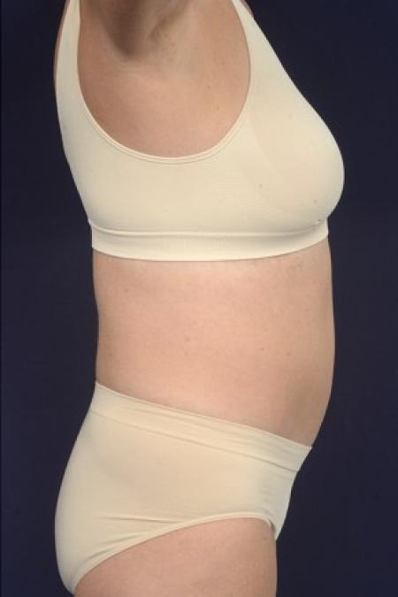 After image 3 Case #87521 - Trunk Liposuction