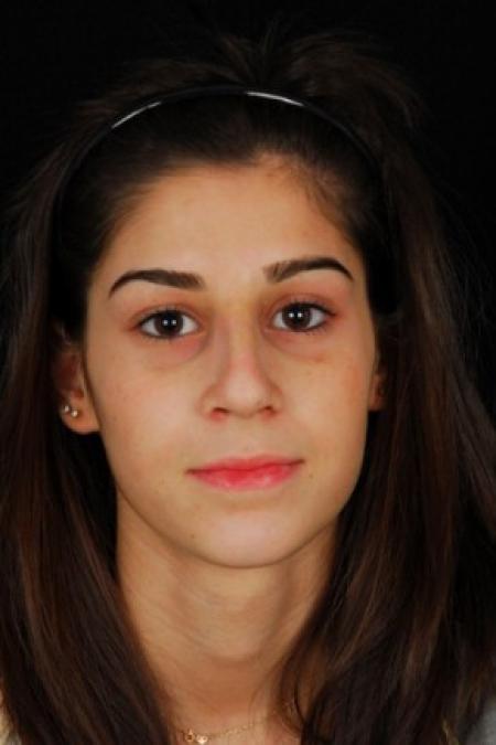 After image 1 Case #81561 - Rhinoplasty