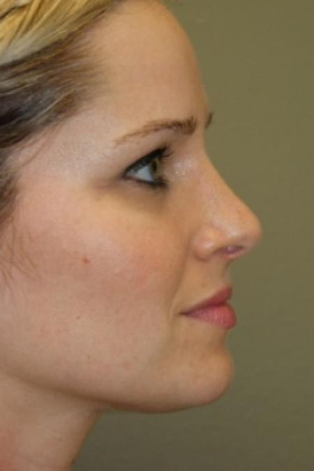 After image 2 Case #81286 - Rhinoplasty
