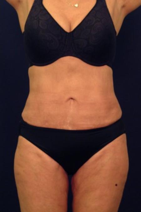 After image 1 Case #87676 - Liposuction