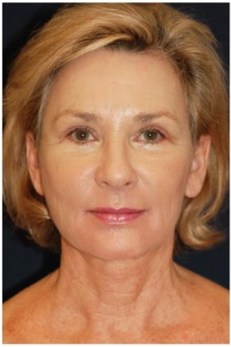 After image 1 Case #82136 - Facelift