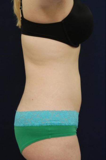 After image 3 Case #87726 - Liposuction