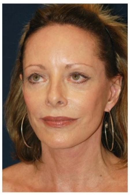 After image 2 Case #82041 - Full Facial Rejuvenation