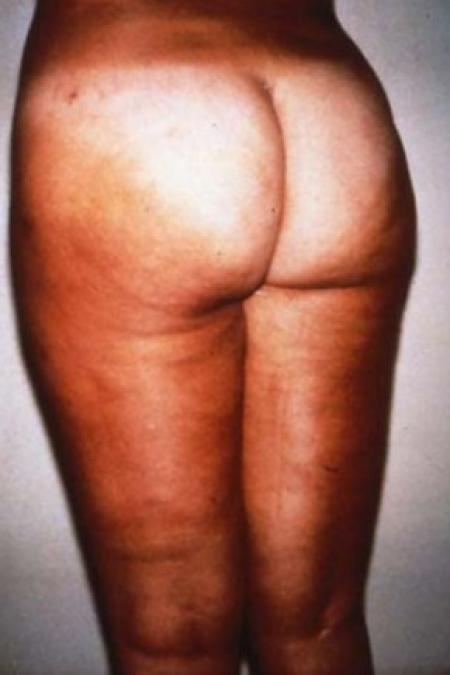After image 1 Case #81621 - Liposuction