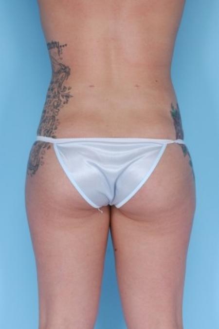 After image 2 Case #82286 - Liposuction