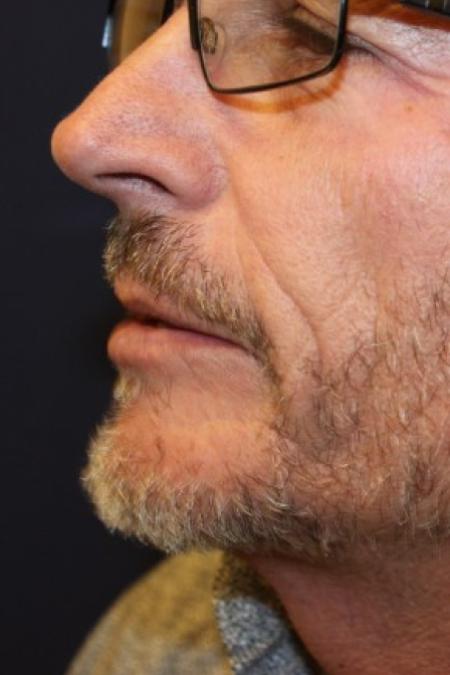After image 3 Case #87371 - Hair Transplantation San Diego