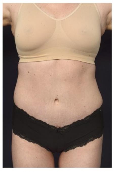 After image 1 Case #85561 - Abdominoplasty