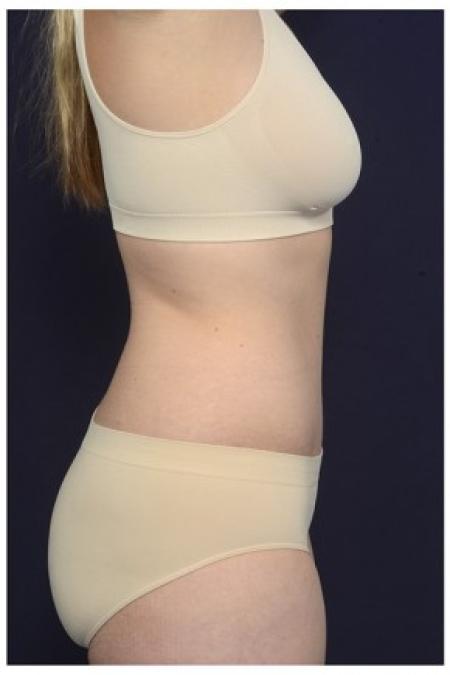 After image 3 Case #87556 - Abdominoplasty