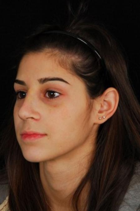 After image 2 Case #81561 - Rhinoplasty