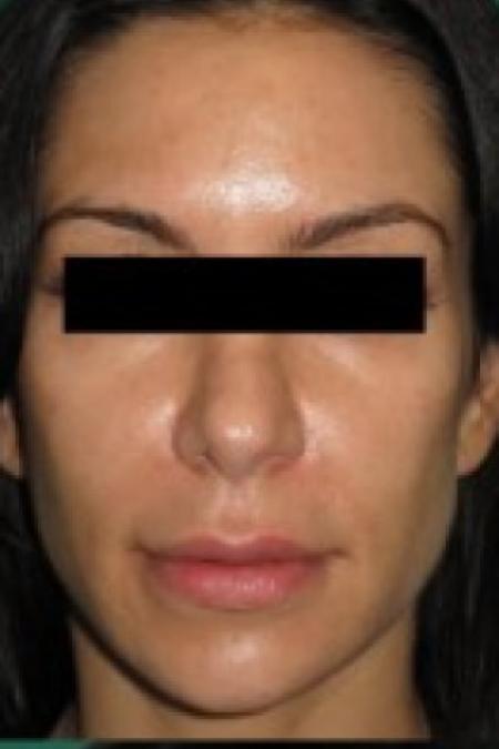After image 1 Case #85656 - Rhinoplasty 