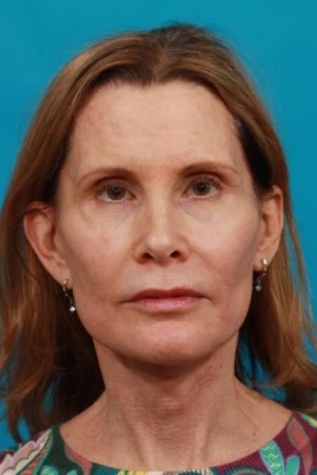 After image 1 Case #84016 - Secondary Face / Neck Lift