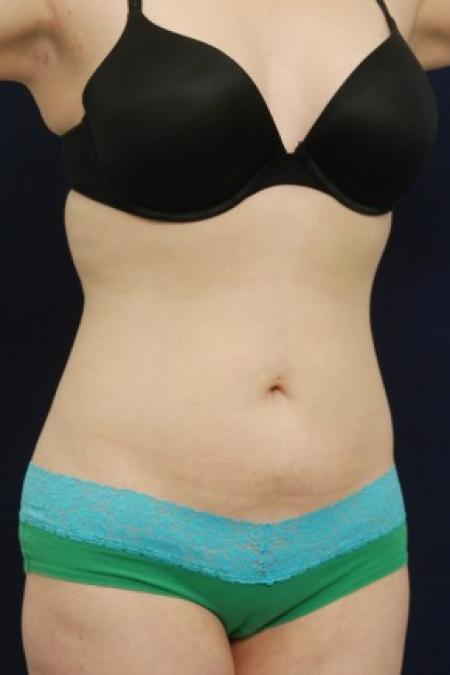 After image 2 Case #87726 - Liposuction