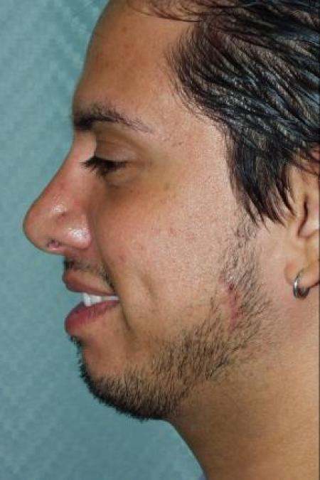 After image 1 Case #80906 - Rhinoplasty