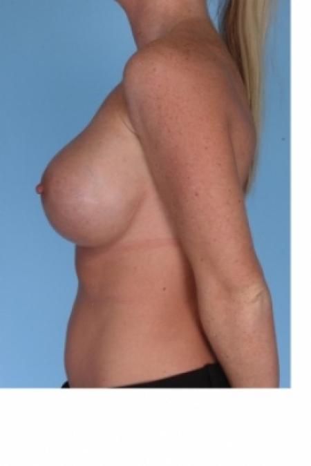 After image 3 Case #80556 - Breast Implant Replacement