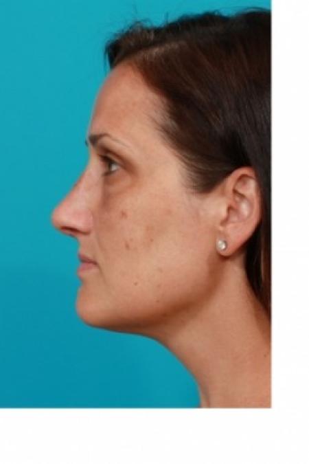 After image 3 Case #81066 - Open Rhinoplasty