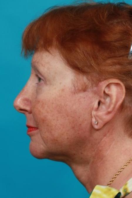 After image 3 Case #83001 - Facial Rejuvenation