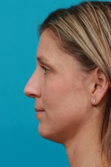 After image 3 Case #80521 - Open Rhinoplasty