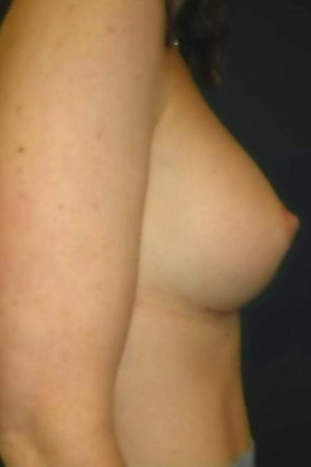 After image 3 Case #82891 - Breast Augmentation using Smooth Round Silicone Gel Implants