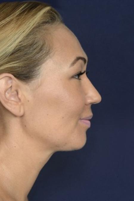 After image 3 Case #87151 - Neck / Chin Liposuction