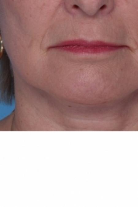 After image 1 Case #80571 - Chin Liposuction
