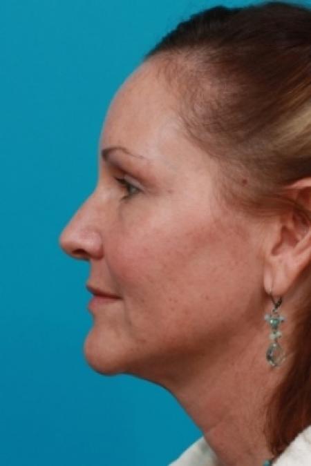 After image 2 Case #78891 - Upper Blepharoplasty