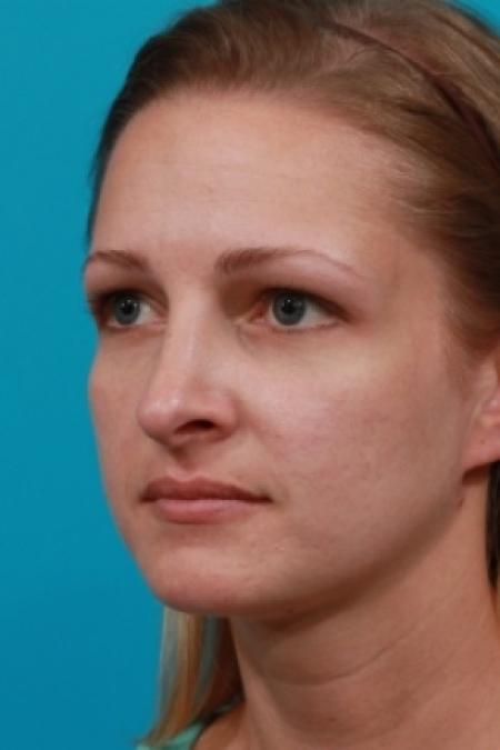 After image 2 Case #78781 - Rhinoplasty (Nose Reshaping)