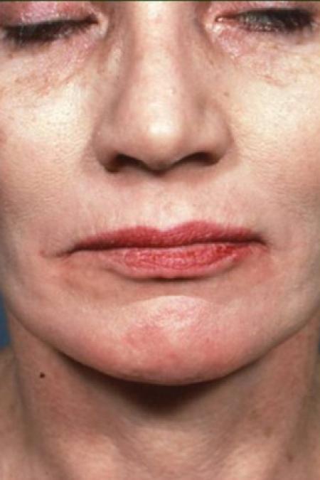 After image 1 Case #81586 - Chemical Peel / Facelift