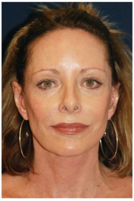 After image 1 Case #82041 - Full Facial Rejuvenation
