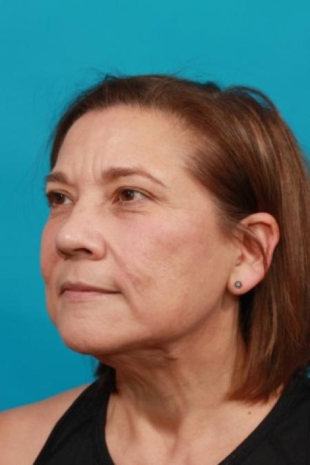 After image 2 Case #85621 - Neck / Lower Face Lift