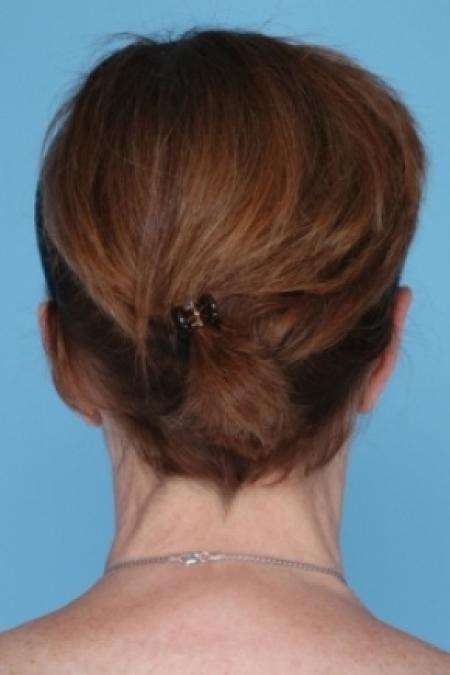 After image 2 Case #79516 - Ear Surgery