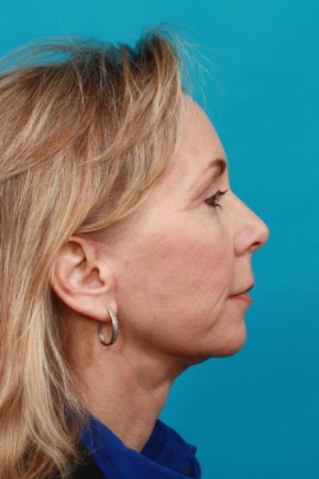 After image 3 Case #86511 - Neck Lift