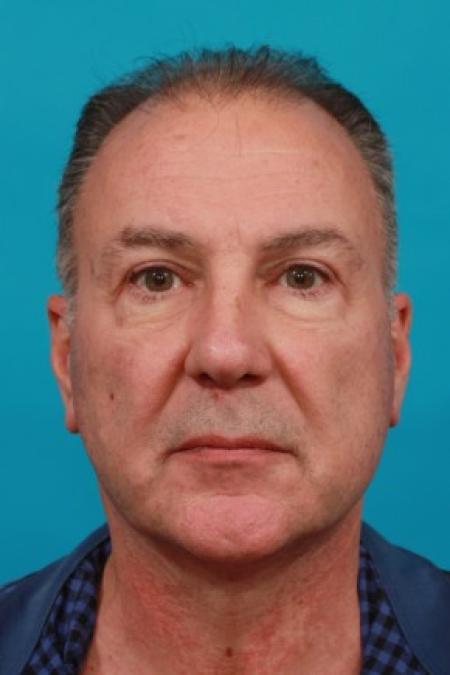 After image 1 Case #86521 - Male Facial Rejuvenation