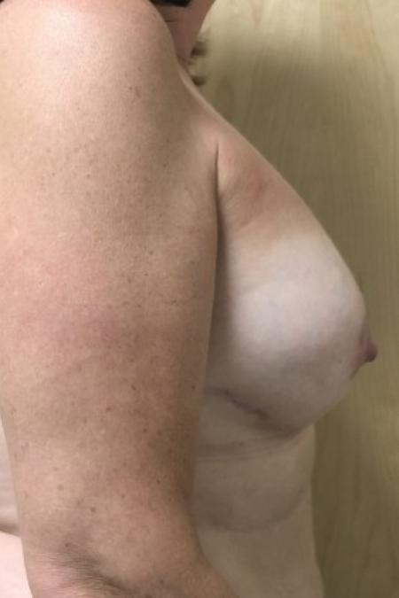 After image 3 Case #87246 - Direct-To-Implant Based Breast Reconstruction 